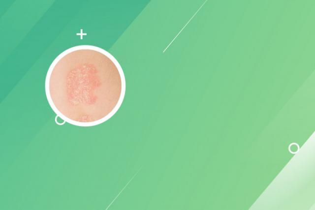 哈尔滨治银屑病牛皮癣正规医院